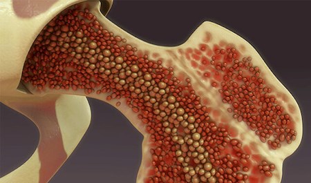 روش جدید برای درمان سرطان مغز استخوان