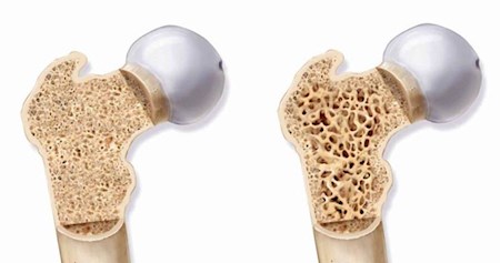 درمانی جدید برای پوکی استخوان