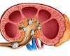 چه کنیم که سنگ کلیه عود نکند؟