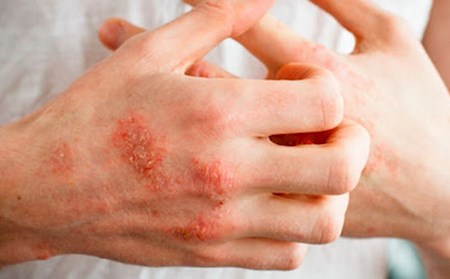 برخی عوارض پوستی علامت ابتلا به کرونا است