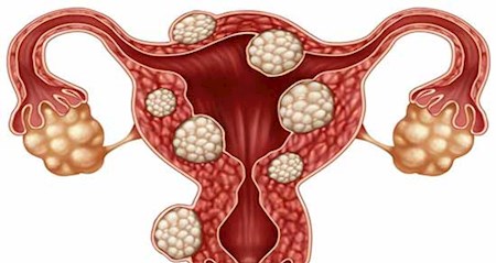 مواد خوراکی از بین برنده فیبروم رحم