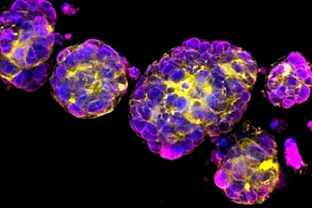 واکسن mRNA برای درمان سرطان از راه رسید