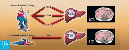 ورزش و کبد چرب الکلی و غیرالکلی