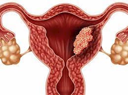 سرطان تخمدان؛ قاتل خاموش زنان